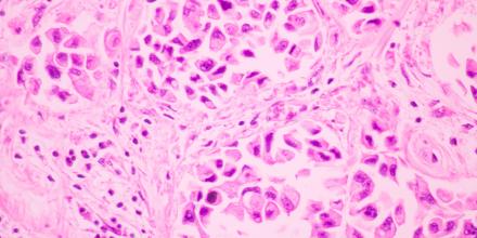Section tissue of breast cancer view in microscopy. Ductal cell carcinoma. Tones of pink 