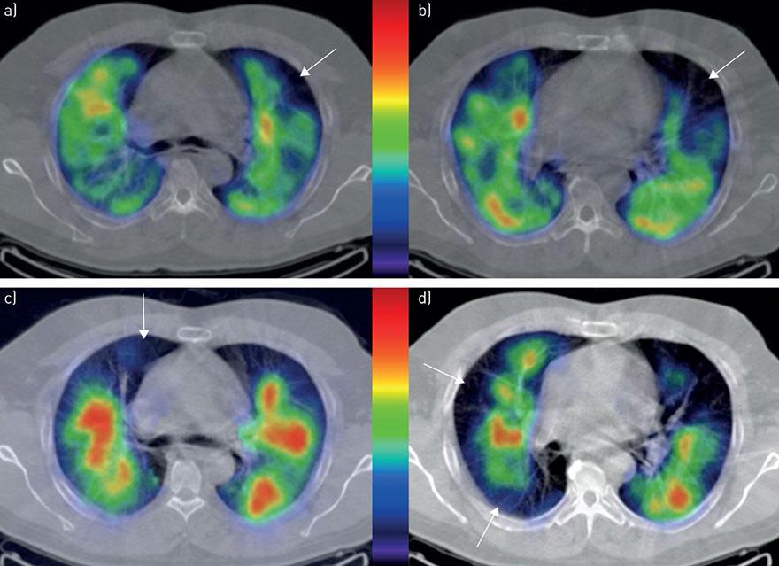 MRI of lungs 