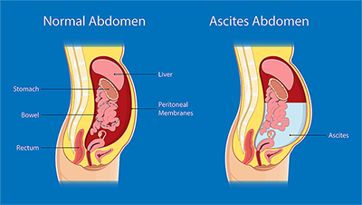 Illustration of normal abdomen and ascites abdomen has blue background and side cross-section of a normal abdomen with organs and ascites abdomen with fluid build up
